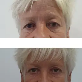 Upper eyelid blepharoplasty | before and after