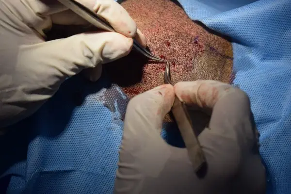 Use of forceps for extraction of follicles