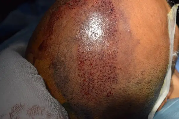 Lateral slits before implantation