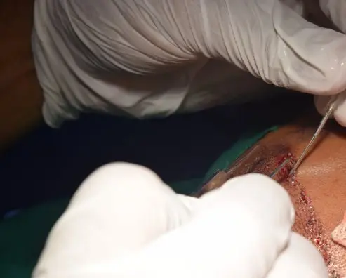 Implantation of the follicular units