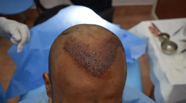 New hairline with transplanted follicles