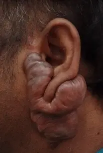 Periauricular keloid