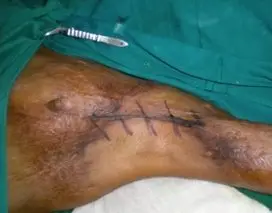 Post-burn contracture of the axilla