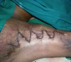 Axillary contracture released with multiple Z-plasty