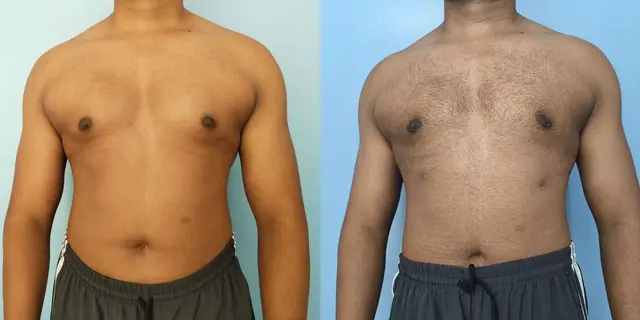 Gynecomastia | Frontal view | After liposuction and gland excision | Early post-op appearance