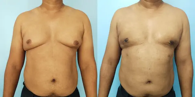 Gynecomastia | Frontal view | After liposuction and gland excision | Individual with skin laxity | Skin recoil takes longer in an older individual