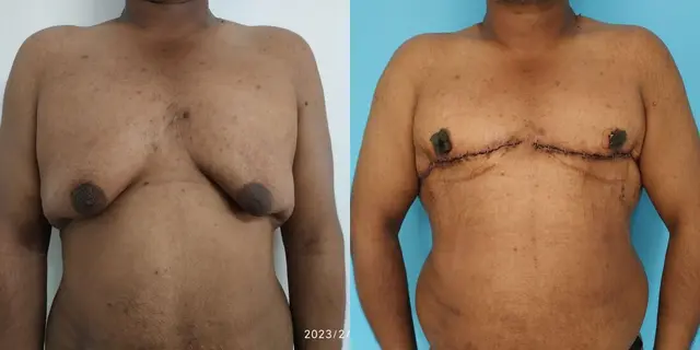 Single stage gynecomastia correction with skin excision and free nipple areola grafting | Individual with massive weight loss | Early post-operative appearance