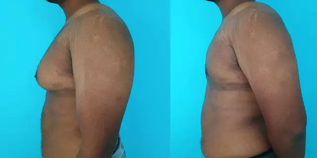 Gynecomastia | Lateral view | After liposuction and gland excision