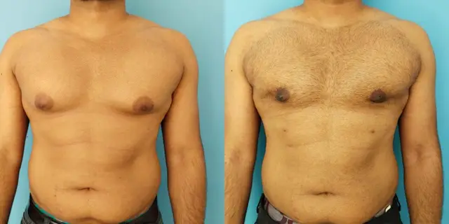 Gynecomastia | Frontal view | After liposuction and gland excision | Minimal contour abnormalities are expected to settle in a few months