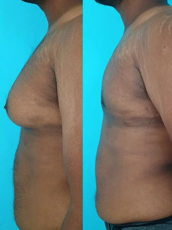Gynecomastia | Before and After