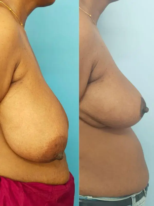 Breast reduction | Before and After