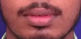 Before lower lip reduction