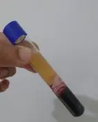 PRP | The spun sample separates into a platelet rich fraction.