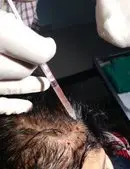 PRP | It is injected into the scalp.