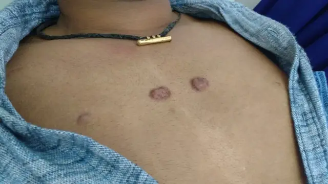 Sternal keloids