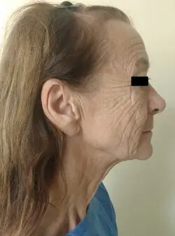 Before facelift and neck lift