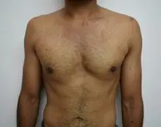 Patient was treated with liposuction and gland excision. He was advised about the need to make get help for correction of the muscle asymmetry.