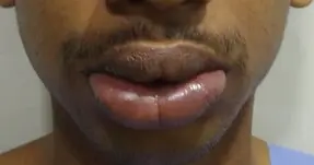 Before upper and lower lip reduction