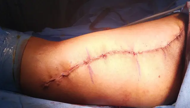Immediate appearance after brachioplasty.