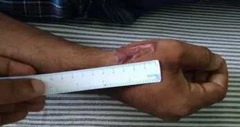 Hypertrophic scar of the hand