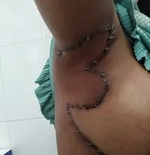 After excision of the affected skin and coverage with a bilobar flap.