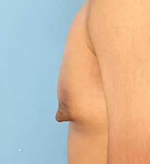 Before gynecomastia correction and nipple reduction