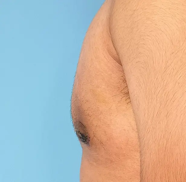 After gynecomastia correction and nipple reduction
