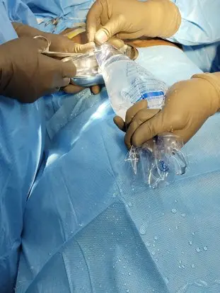 Keller Funnel being used in breast augmentation