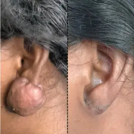 Keloids treated with surgery and radiotherapy | before and after