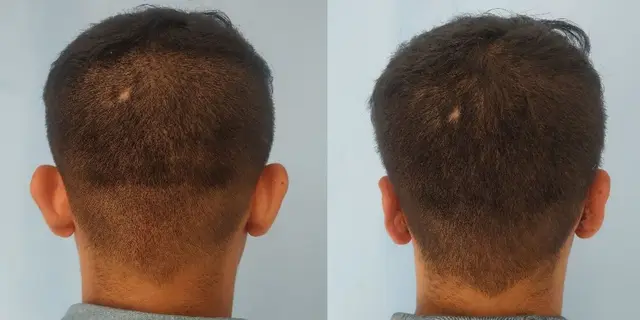 Pushback otoplasty | Posterior view | Davis and Mustarde procedures