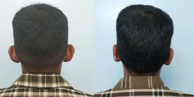 Pushback otoplasty | Posterior view | Davis and Mustarde procedures