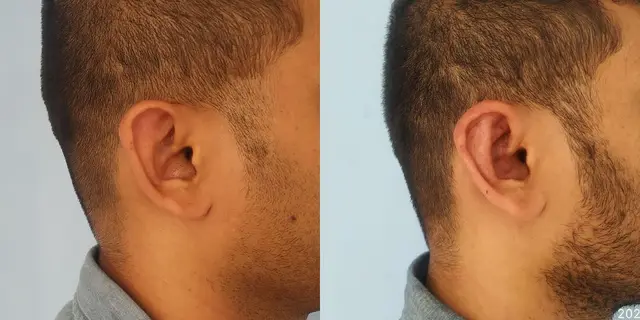 Pushback otoplasty | Lateral view | Davis and Mustarde procedures