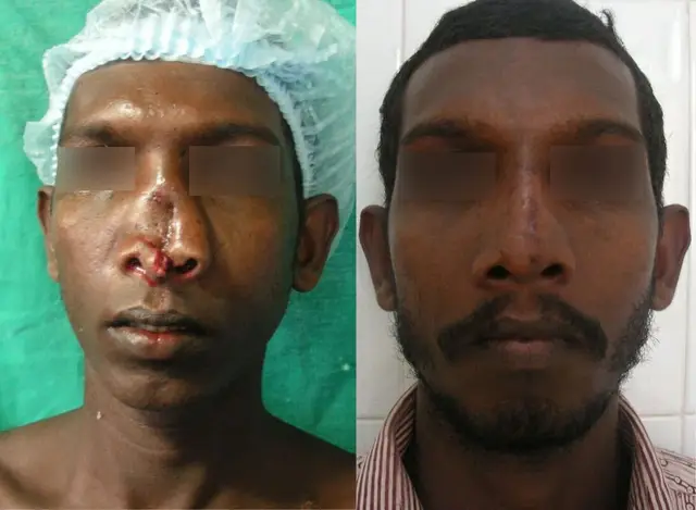 Reconstruction following trauma with primary iliac bone grafting.