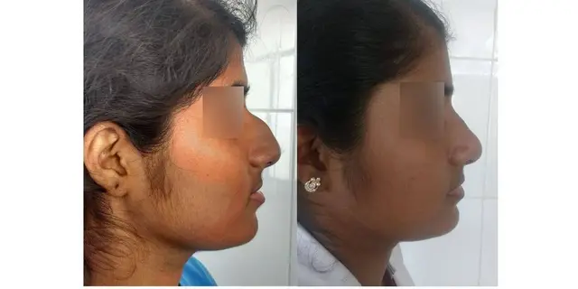Hump reduction with structural rhinoplasty