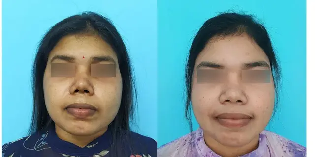 Lengthening of short nose with septal extension graft, tip-plasty and dorsal augmentation.