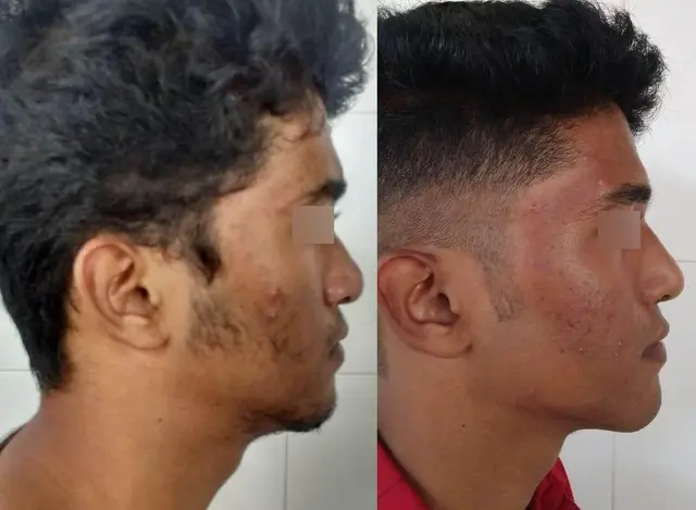 Tip-plasty with dorsal augmentation.