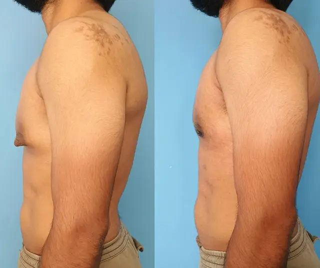 Gynecomastia reduction and nipple reduction. Post-operative appearance at 2 weeks.