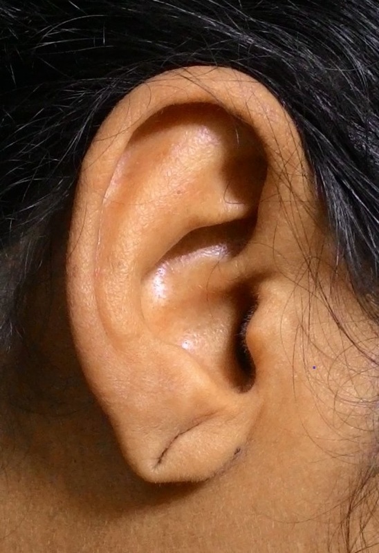 before ear lobe repair with cosmetic surgery