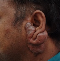 Keloid around the left ear associated with itching and pain