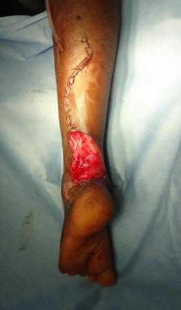 Following debridement and coverage with a distally based fasciocutaneous flap