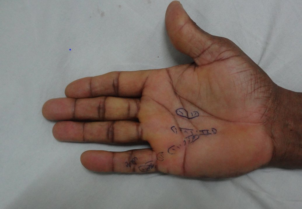 Dupuytren's disease of hand with cords marked in blue