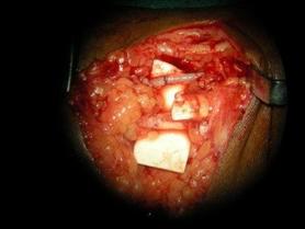 Primary median nerve repair with end to end anastomosis of the radial artery.