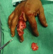 After excision of recurrent benign tumor of hand after extensor tenotomy