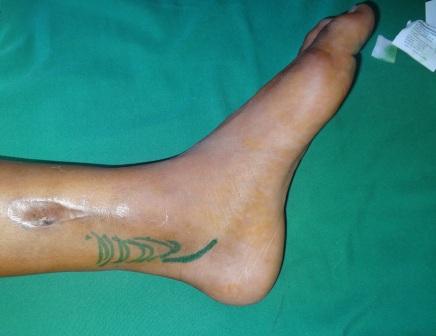 Post-trauma flexion contracture of the big toe