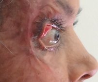 Post-burn contracture of eyelids