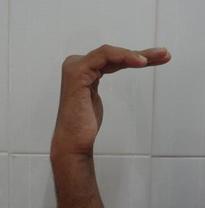 Early postoperative picture which shows claw deformity