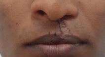 Stretched out scar of the upper lip.