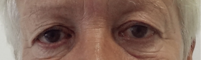 Tired looking eyes due to excess folds in the upper eyelids