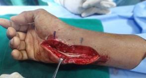 Following repair of the ulnar nerve with cable grafts obtained from the sural nerve.