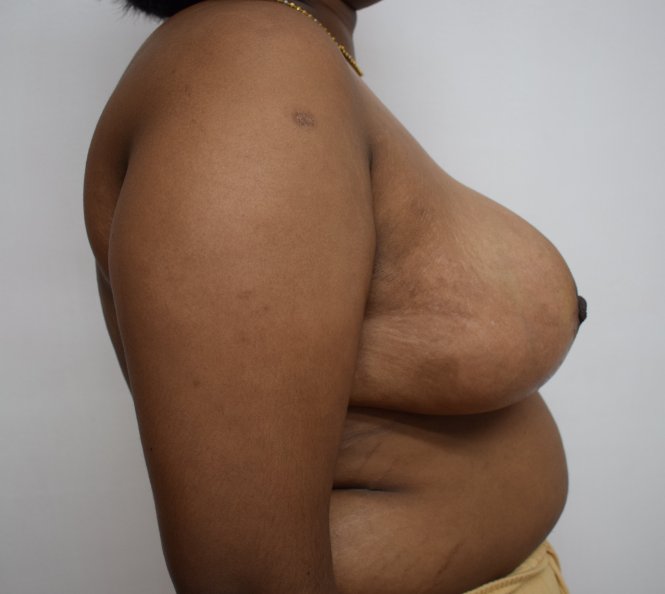 After breast reduction (at one month post-op) 
